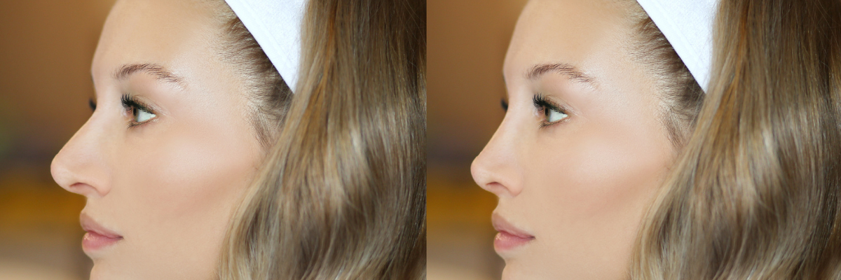 Rhinoplasty Session